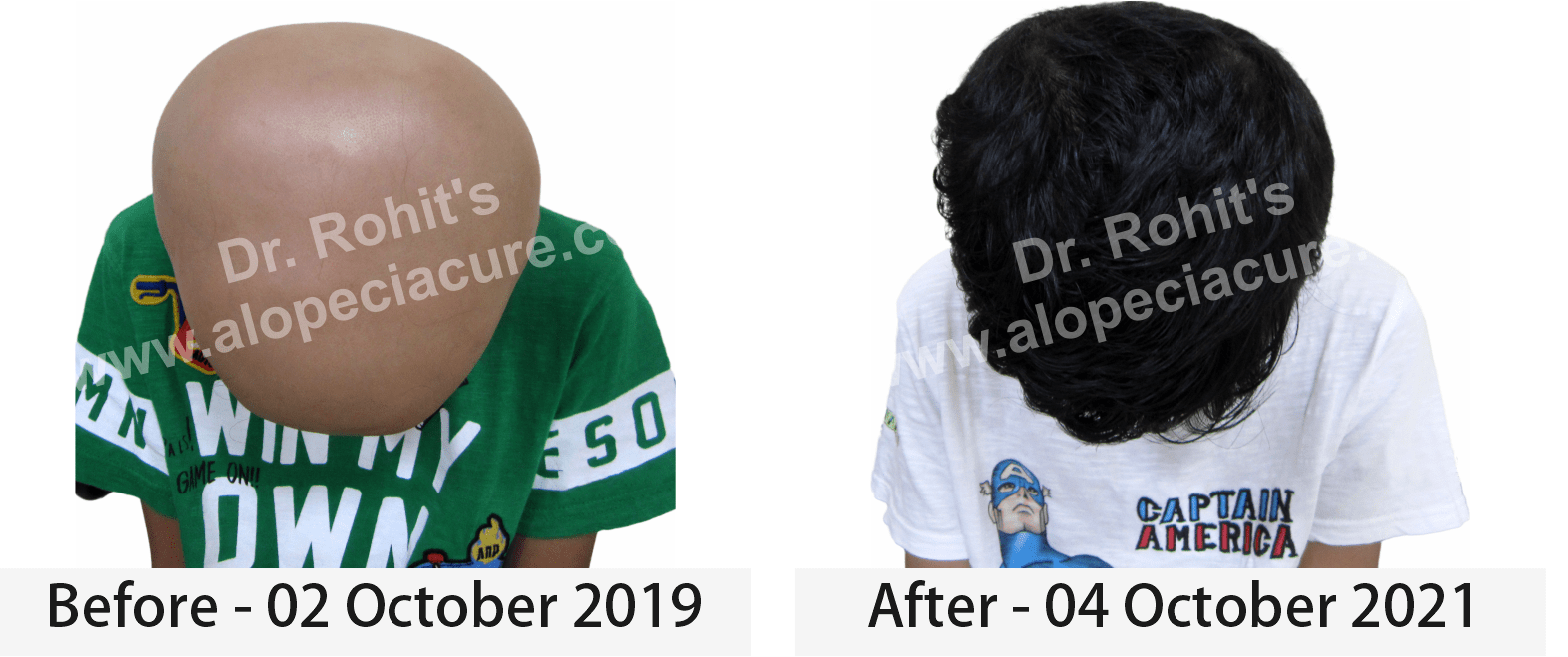 hair loss treatment